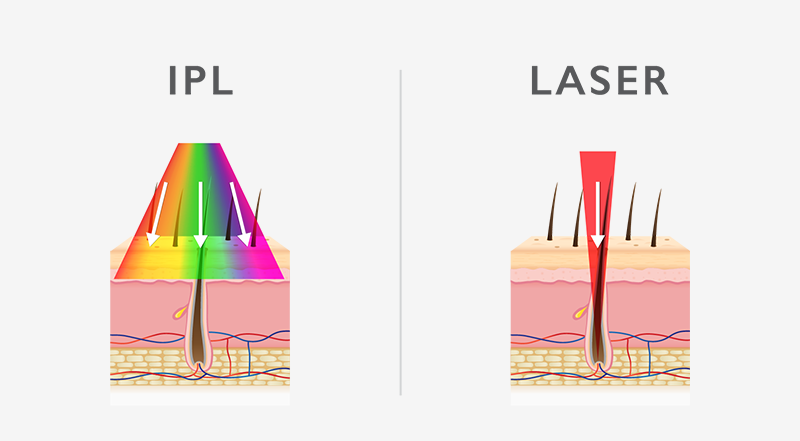 IPL vs Laser Hair Removal post thumbnail image